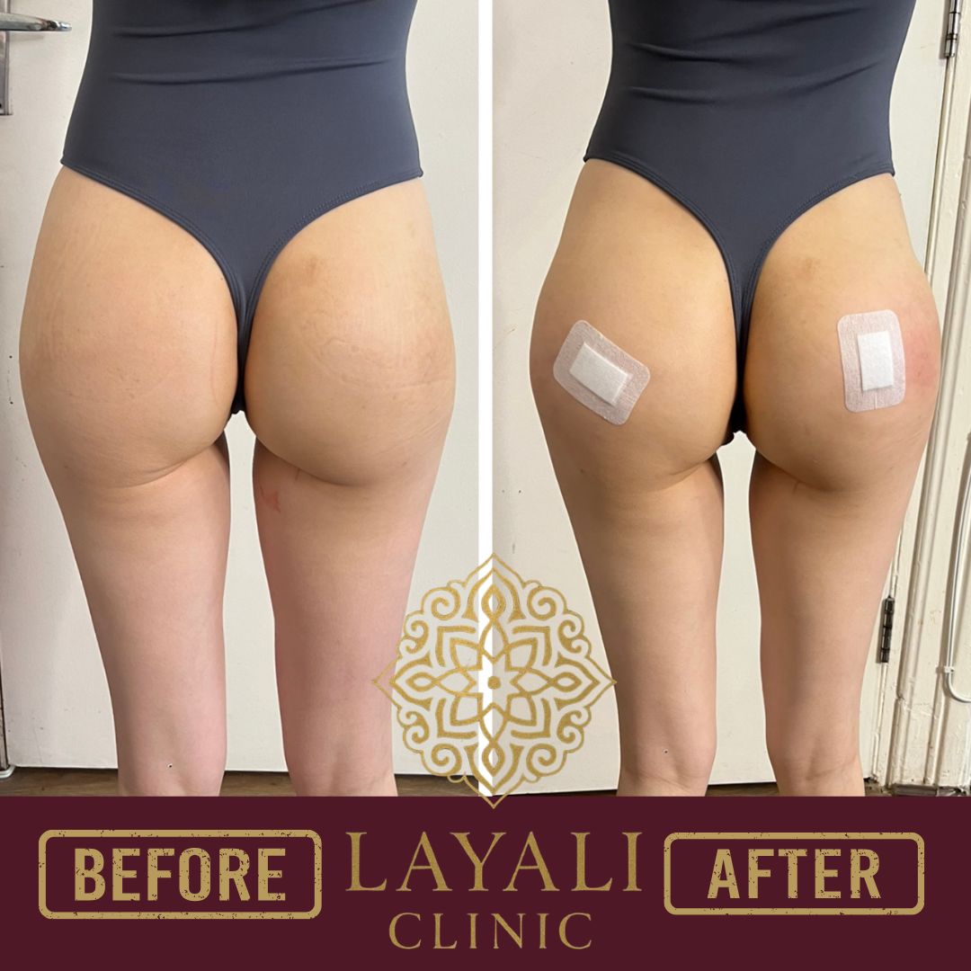 Non-surgical butt filler before and after at Layali Clinic — added volume and a rounder shape