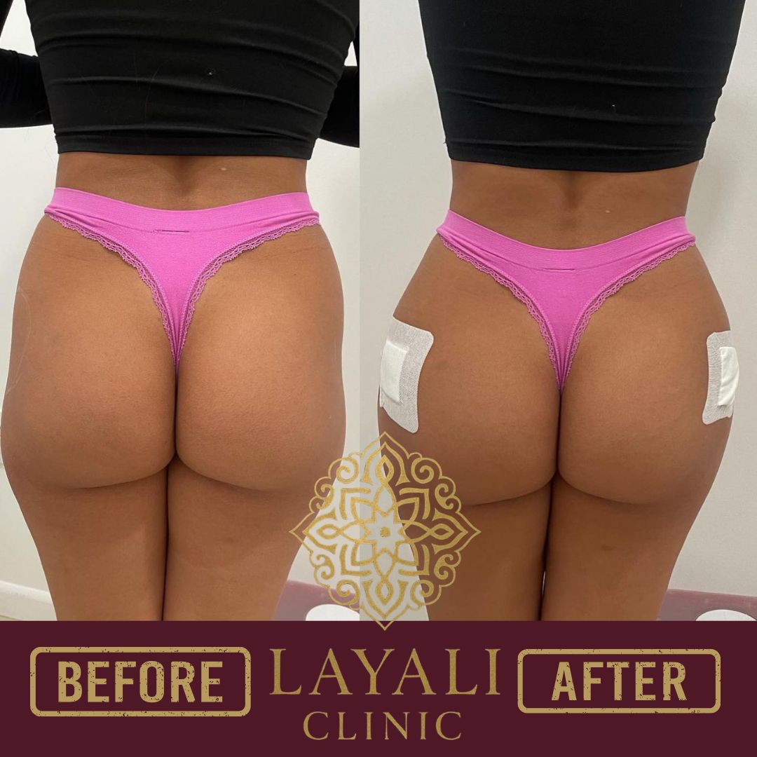 Non-surgical butt filler before and after at Layali Clinic — improved lift and projection