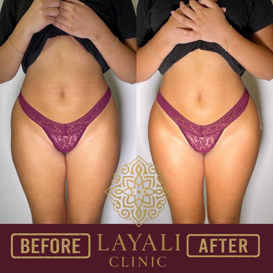 Non-surgical hip and butt filler before and after at Layali Clinic — softer hip dips and smoother contour