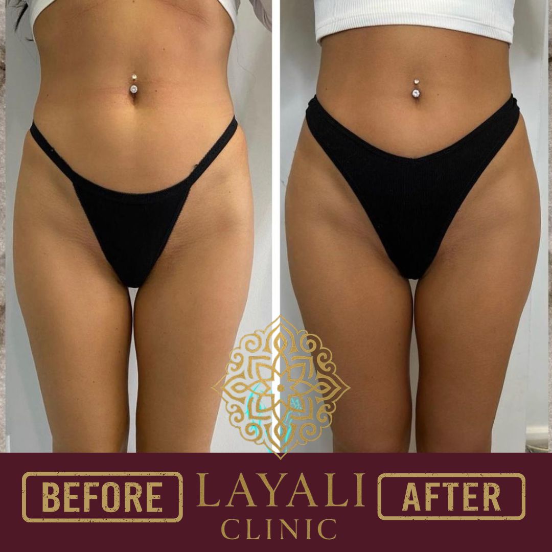 Non-surgical butt filler before and after at Layali Clinic — a more balanced waist-to-hip line