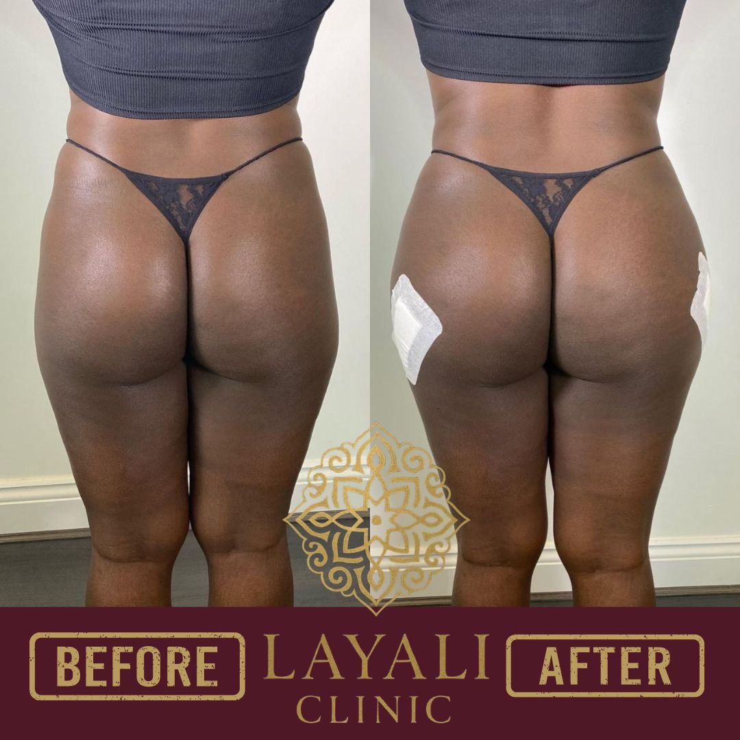 Non-surgical butt filler before and after at Layali Clinic — a fuller, more even shape