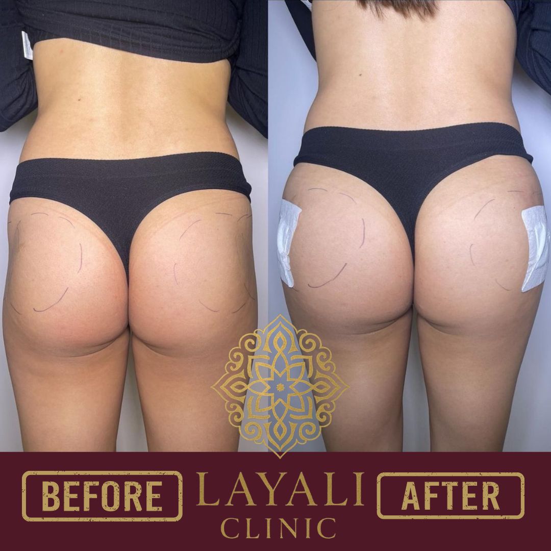 Non-surgical butt filler before and after at Layali Clinic — enhanced projection and lift