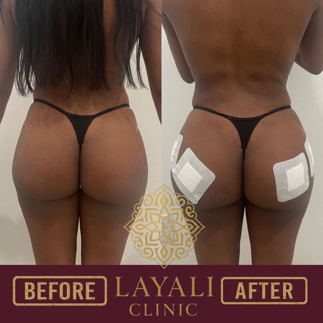 Non-surgical hip and butt filler before and after at Layali Clinic — a rounder shape with definition