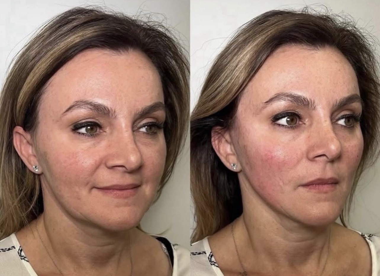 Endolaser before and after — a sharper, more defined jawline