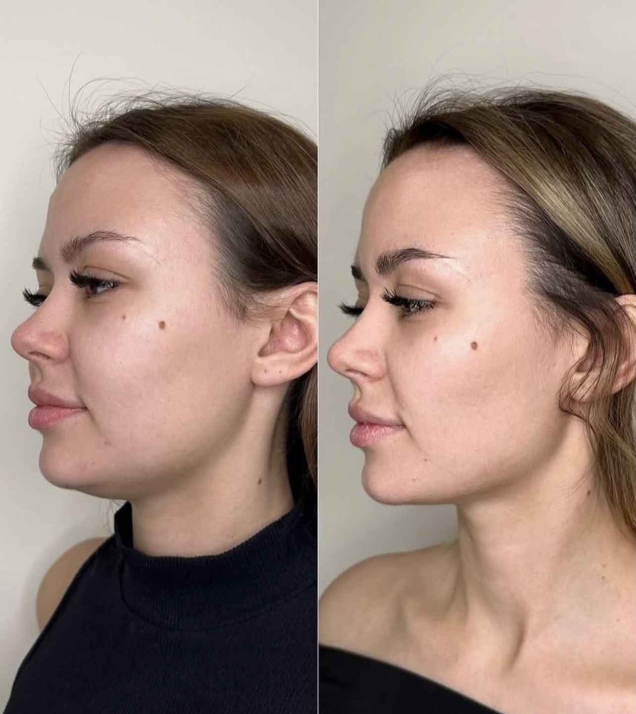 Endolaser before and after — softer jowls and a lifted lower face