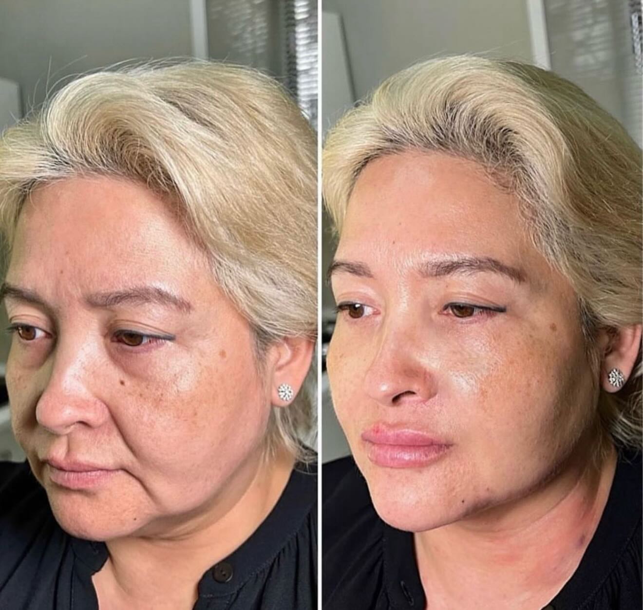 Endolaser before and after — a firmer, more lifted mid-face