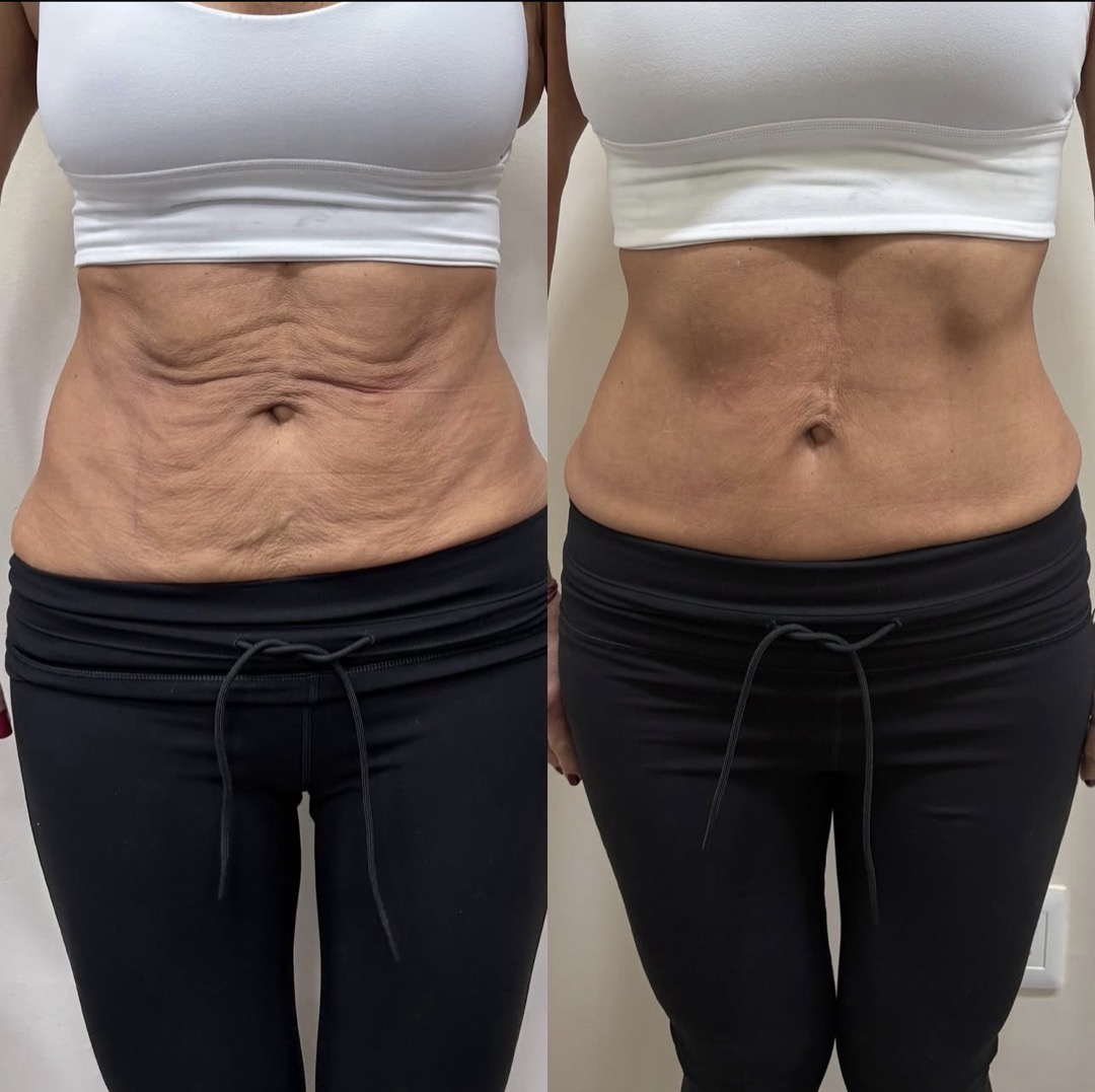 Endolaser abdomen before and after, front view — flatter and firmer