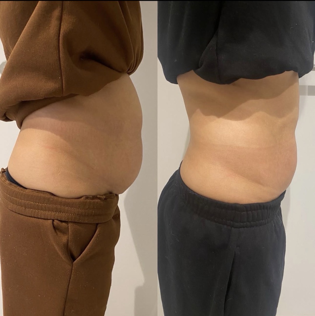 Endolaser abdomen before and after, side profile — a tighter, more contoured waist