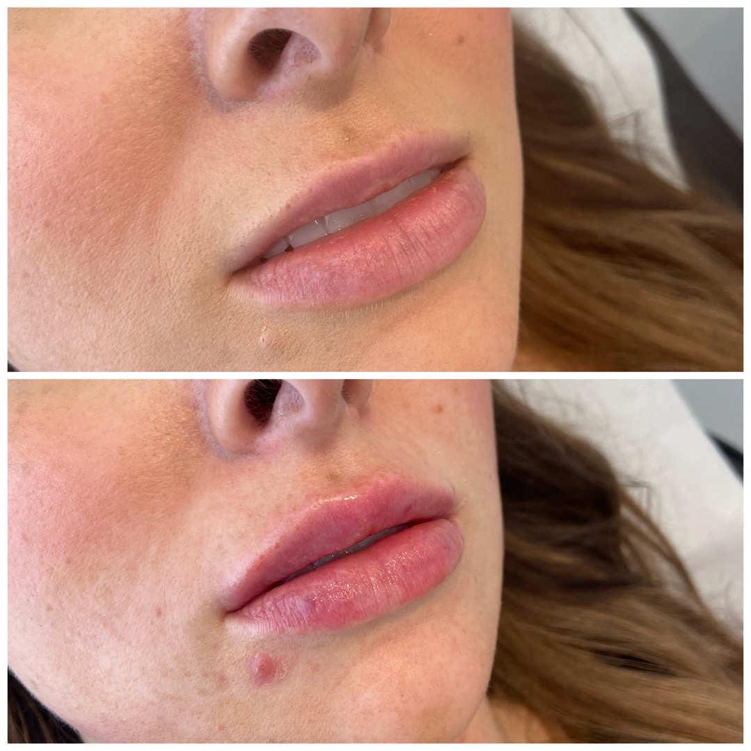 Lip filler before and after