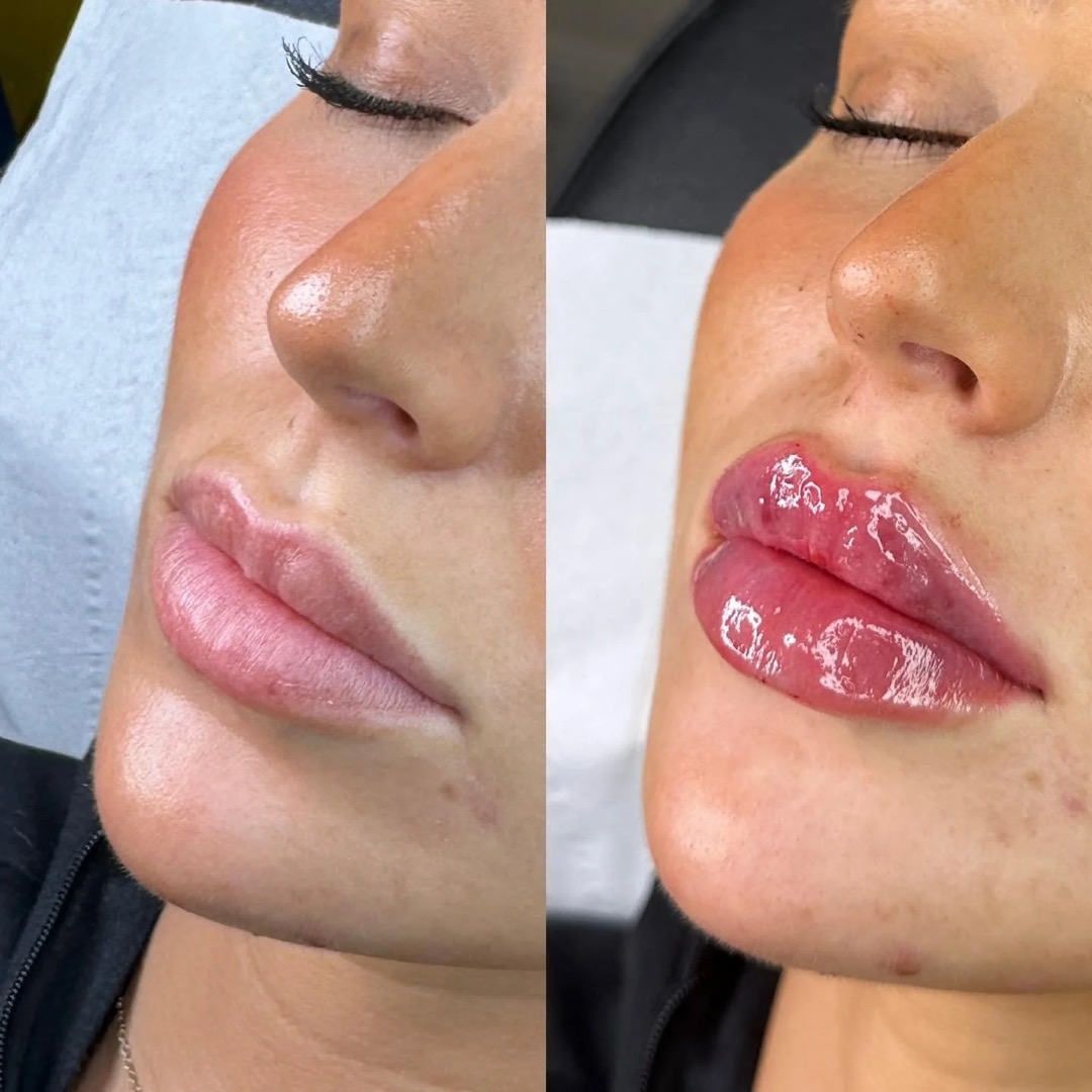 Lip filler before and after at Layali Clinic