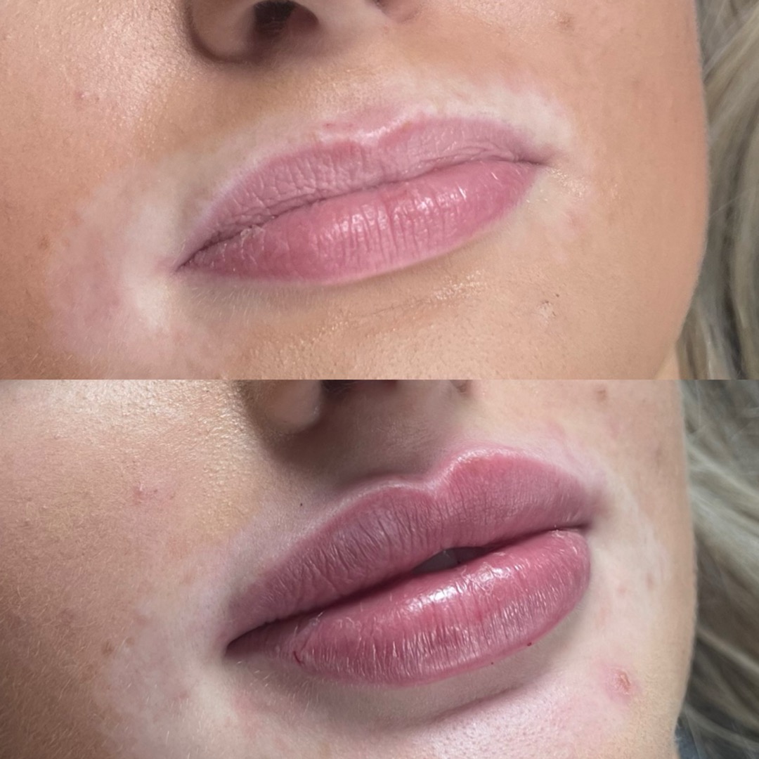 Lip filler before and after